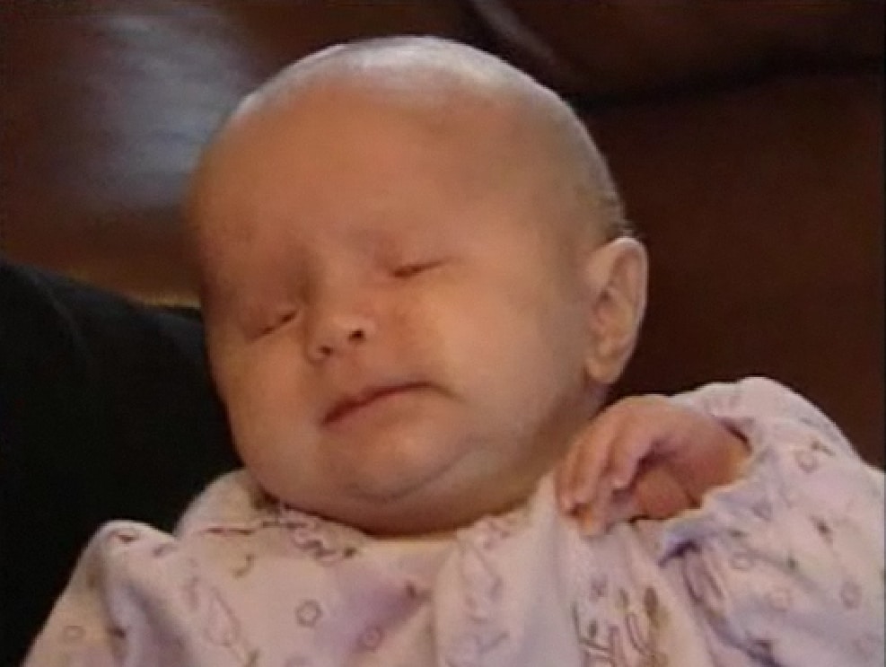 Baby Born Without Eyes: Living With Bilateral Anophthalmia Baby Born Without Eyes: Living With Bilateral Anophthalmia
