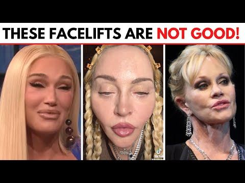 Is It Too Much? Public Reaction To A Celebrity's Facelift Is It Too Much? Public Reaction To A Celebrity's Facelift