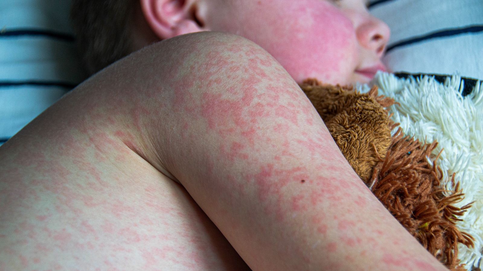 Measles Cases In The U.S.: A State-by-State Update Measles Cases In The U.S.: A State-by-State Update