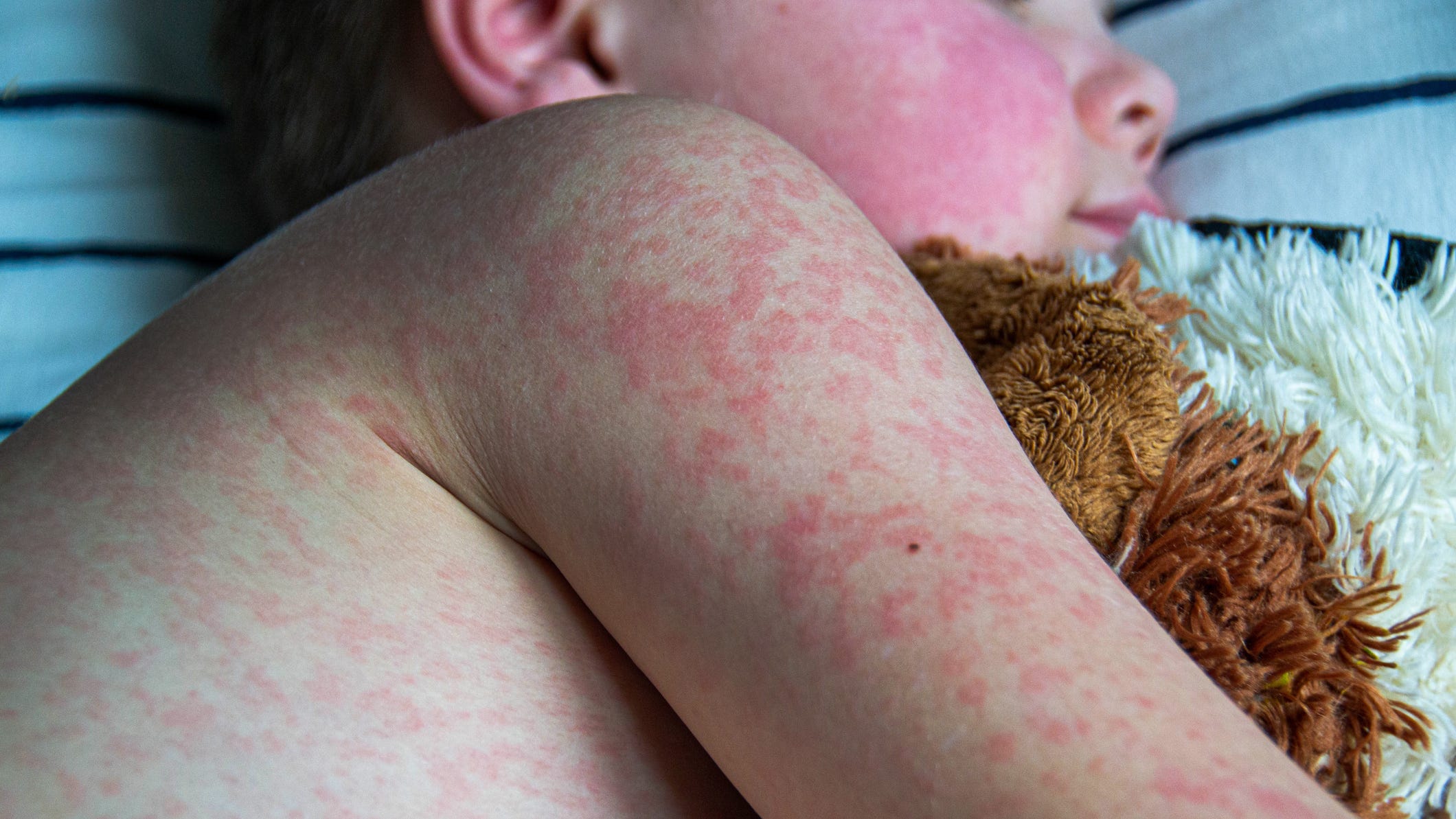 Measles In Texas: Increase In Cases Reported, Separate From Outbreak Measles In Texas: Increase In Cases Reported, Separate From Outbreak