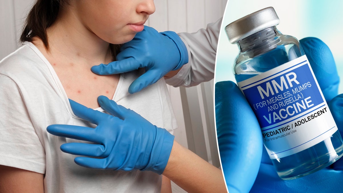 Measles In The U.S.: A Comprehensive Look At The Current Outbreak Measles In The U.S.: A Comprehensive Look At The Current Outbreak