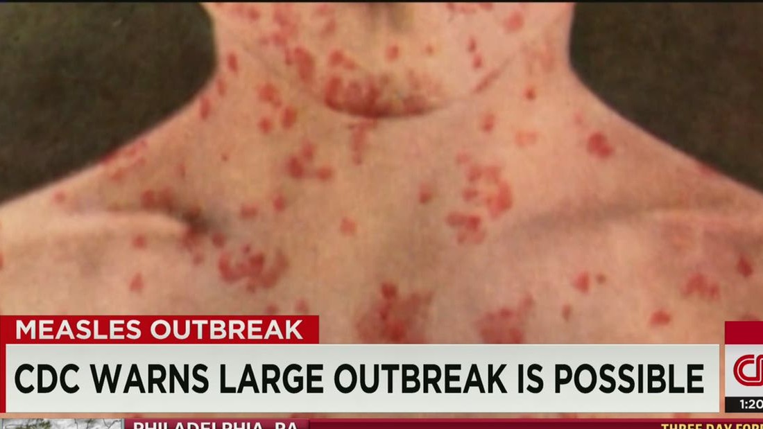 Second Virginia Measles Case In 2025: Details And Public Health Response Second Virginia Measles Case In 2025: Details And Public Health Response