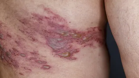 Shingles Vaccination And Dementia Risk: What The Evidence Shows Shingles Vaccination And Dementia Risk: What The Evidence Shows