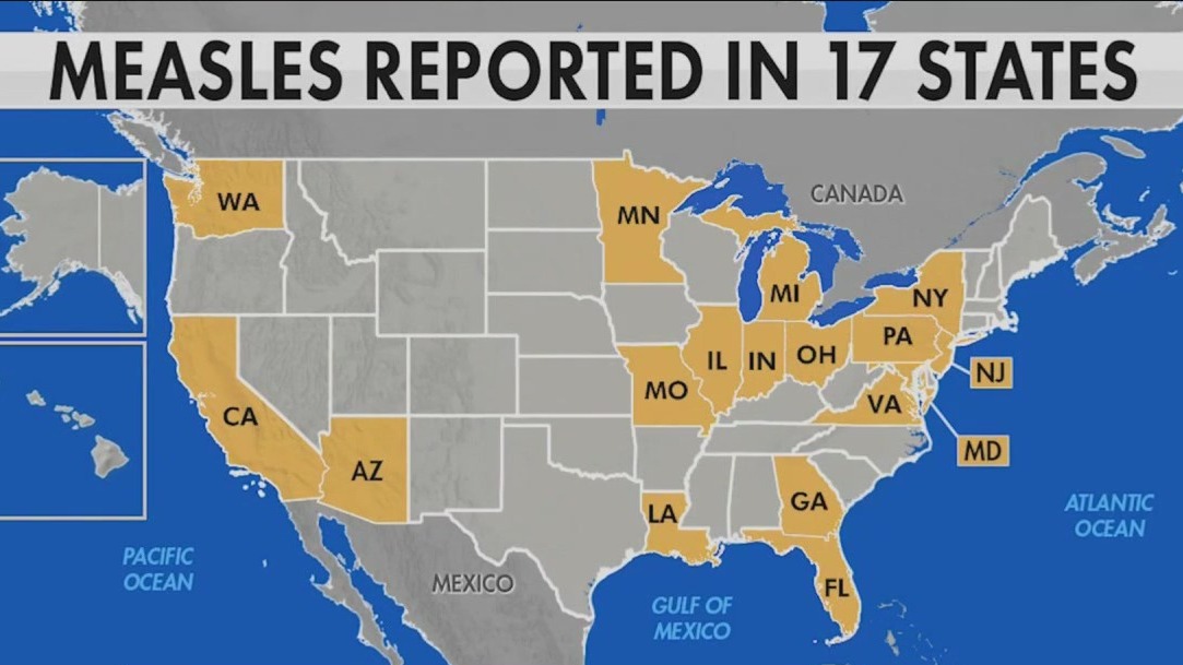 Texas Measles Cases Rise: Unlinked To Major Outbreak Texas Measles Cases Rise: Unlinked To Major Outbreak