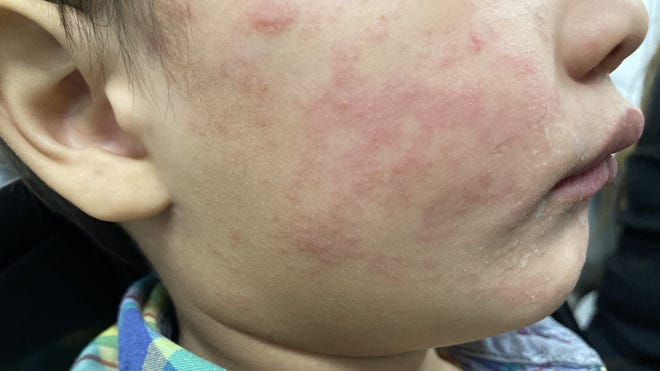 Texas Sees Spike In Measles Cases Unrelated To Current Outbreak Texas Sees Spike In Measles Cases Unrelated To Current Outbreak