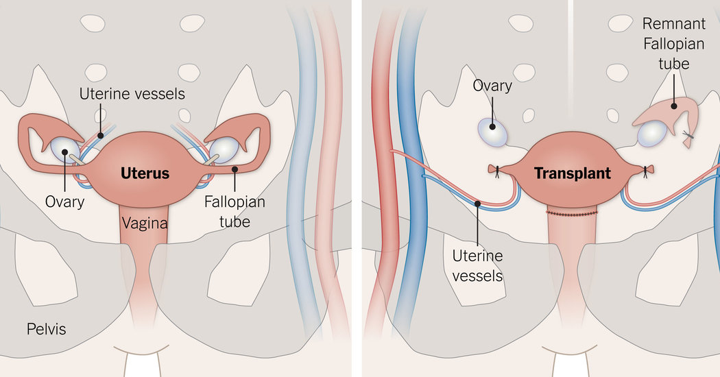 Transgender Pregnancy: Community Activist Advocates For Uterine Transplantation Transgender Pregnancy: Community Activist Advocates For Uterine Transplantation