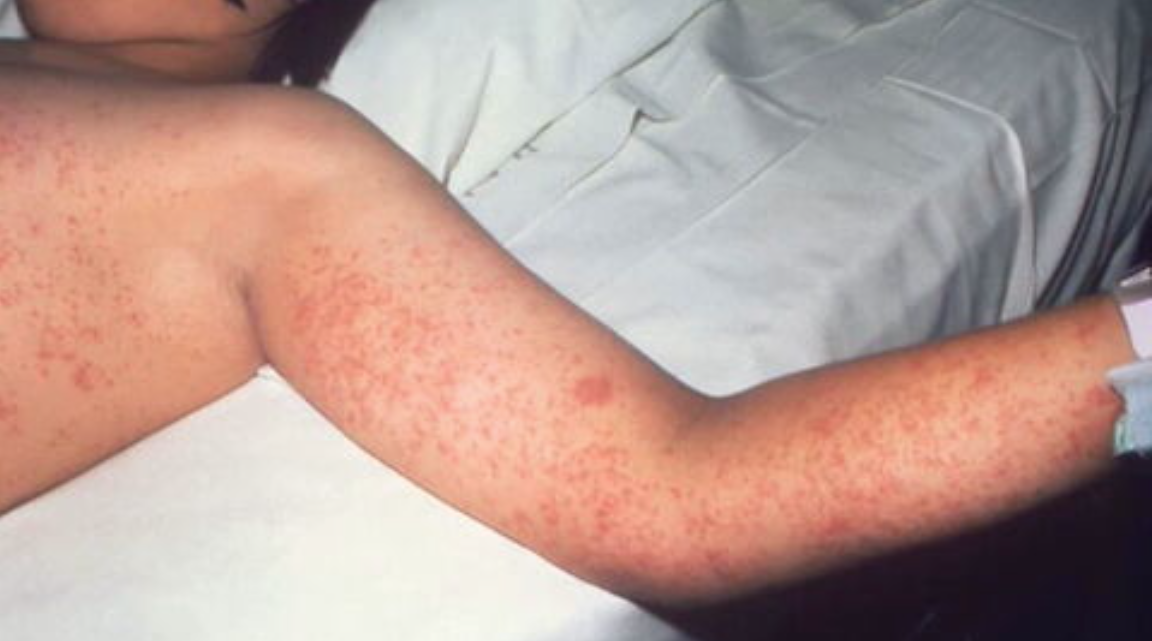 Update: Second Measles Case Reported In Virginia In 2025 Update: Second Measles Case Reported In Virginia In 2025